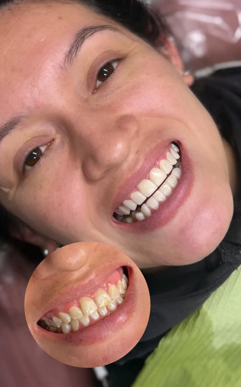 Paciente de Latino Americano Dental sonriendo después de un blanqueamiento dental, junto a una imagen de sus dientes antes del tratamiento